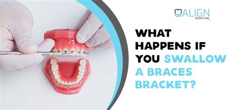 what happens if you swallow a metal bracket|i swallowed my braces wire.